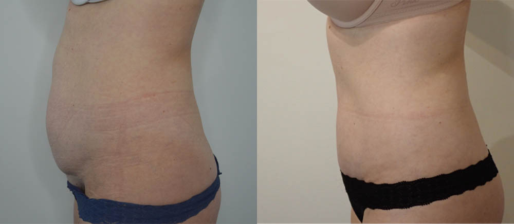 Tummy Tuck case #35802
