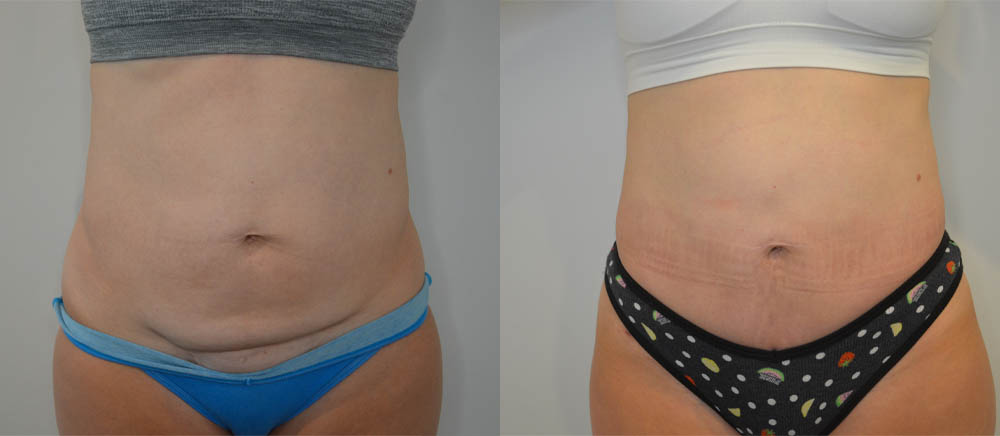 Tummy Tuck case #35806