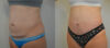 Tummy Tuck case #35806 slider thumbnail