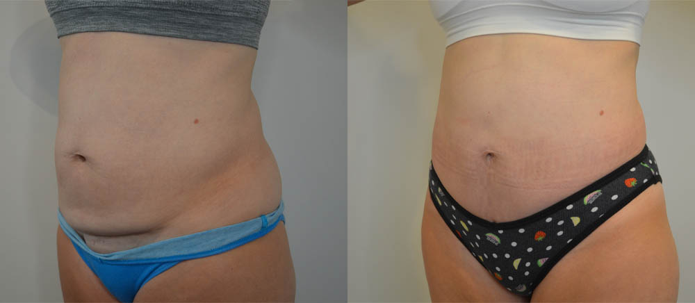 Tummy Tuck case #35806