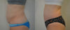 Tummy Tuck case #35806 slider thumbnail