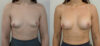 Breast Augmentation case #35781 slider thumbnail