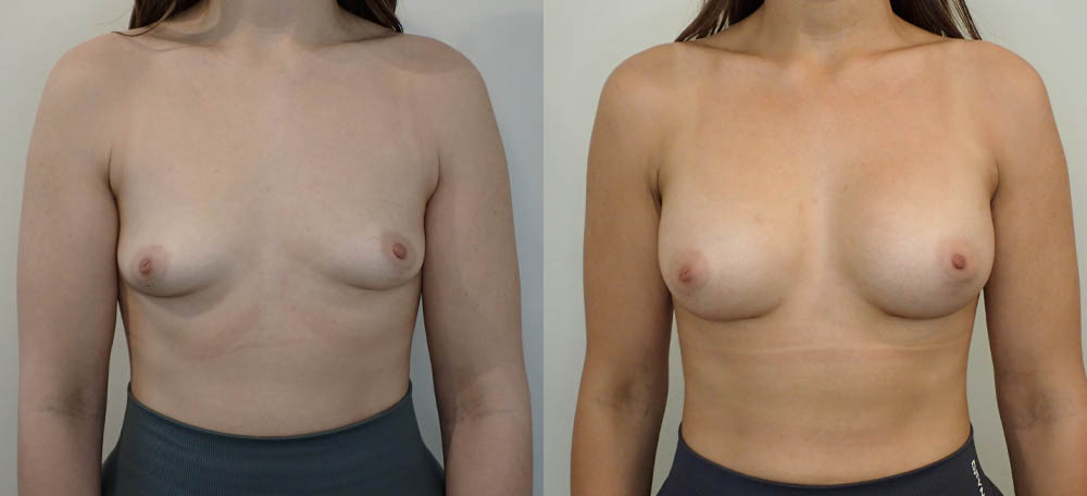 Breast Augmentation case #35781