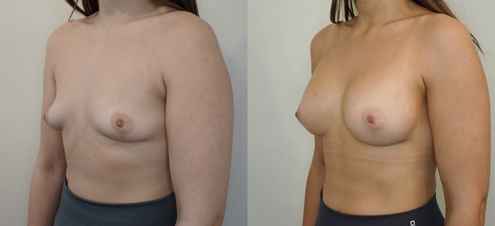 Breast Augmentation case #35781