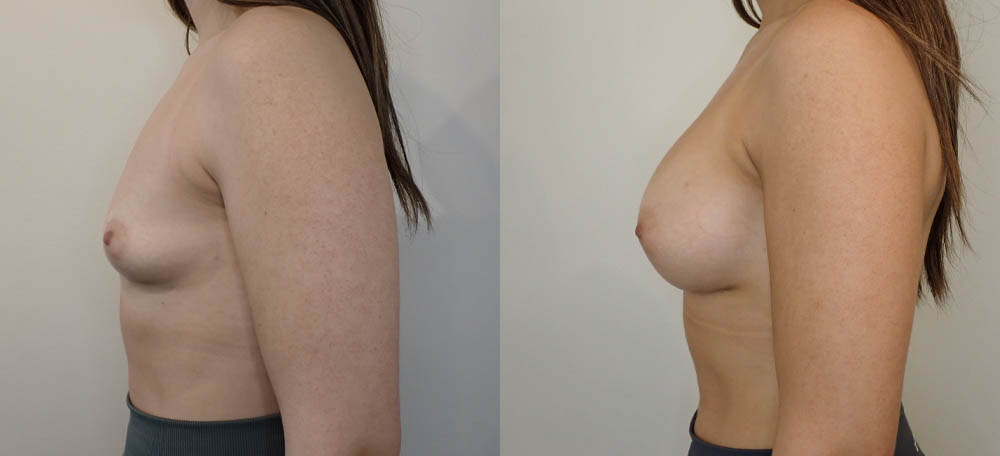 Breast Augmentation case #35781