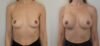 Breast Augmentation case #35785 slider thumbnail