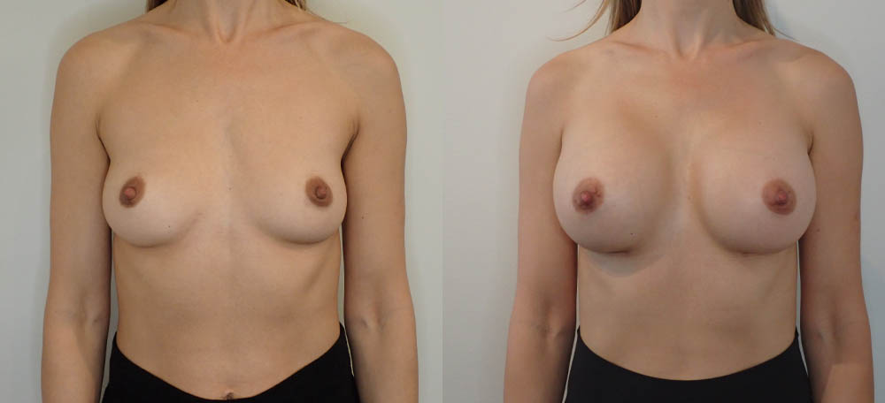 Breast Augmentation case #35785