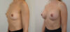 Breast Augmentation case #35785 slider thumbnail
