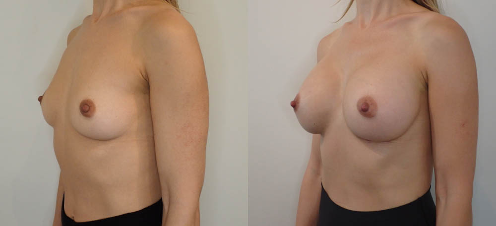 Breast Augmentation case #35785