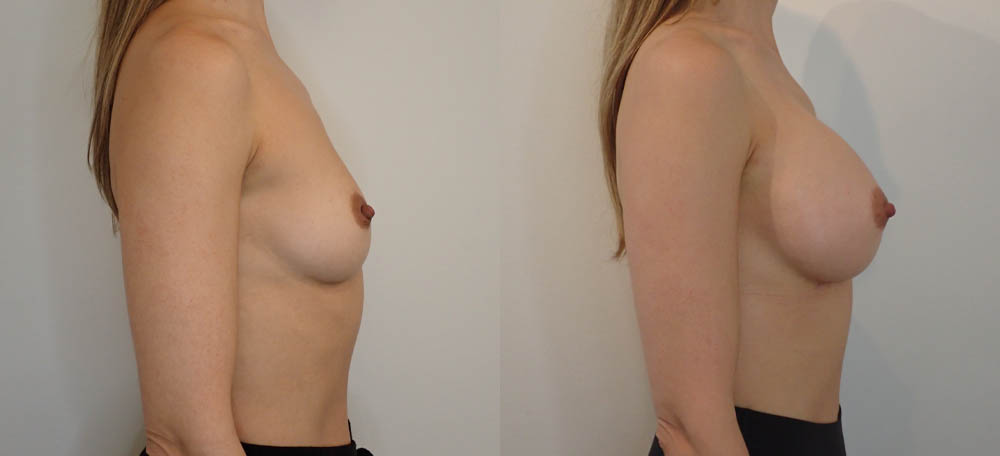 Breast Augmentation case #35785