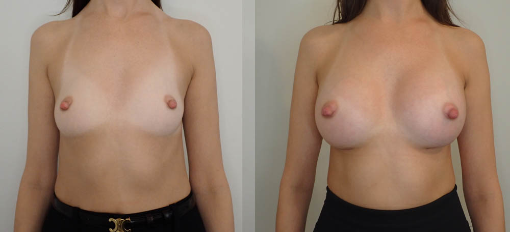 Breast Augmentation case #35789
