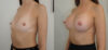 Breast Augmentation case #35789 slider thumbnail