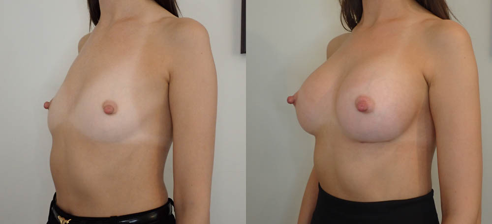 Breast Augmentation case #35789