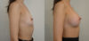 Breast Augmentation case #35789 slider thumbnail