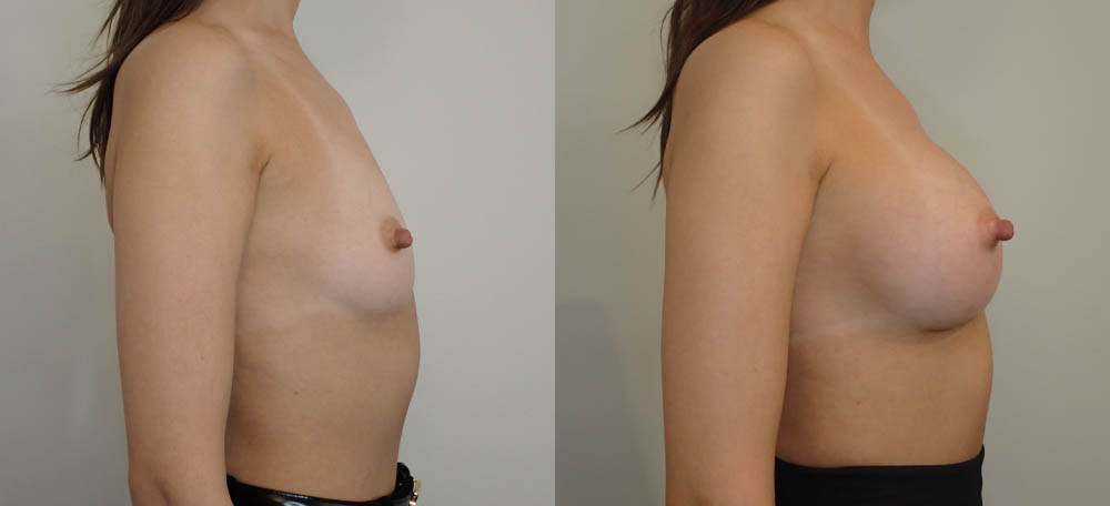 Breast Augmentation case #35789