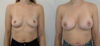 Breast Augmentation case #35793 slider thumbnail