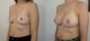 Breast Augmentation case #35793 slider thumbnail
