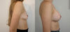 Breast Augmentation case #35793 slider thumbnail