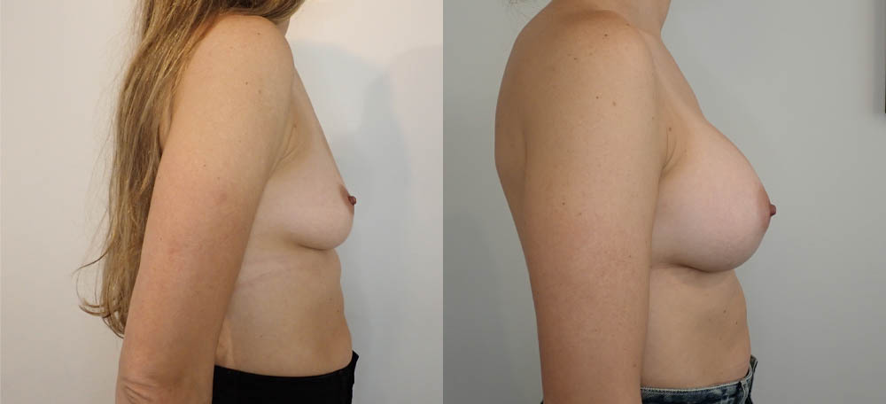 Breast Augmentation case #35793