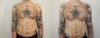 Pectoral Implants case #35777 slider thumbnail
