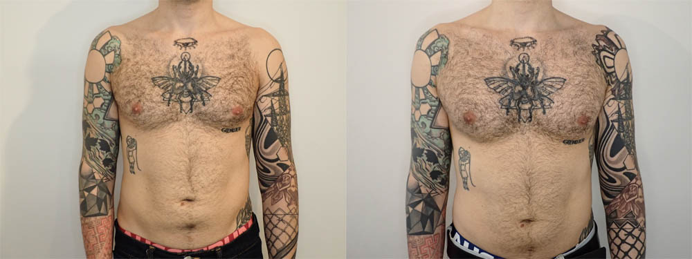 Pectoral Implants case #35777