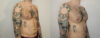 Pectoral Implants case #35777 slider thumbnail
