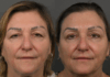 Blepharoplasty case #36183 slider thumbnail