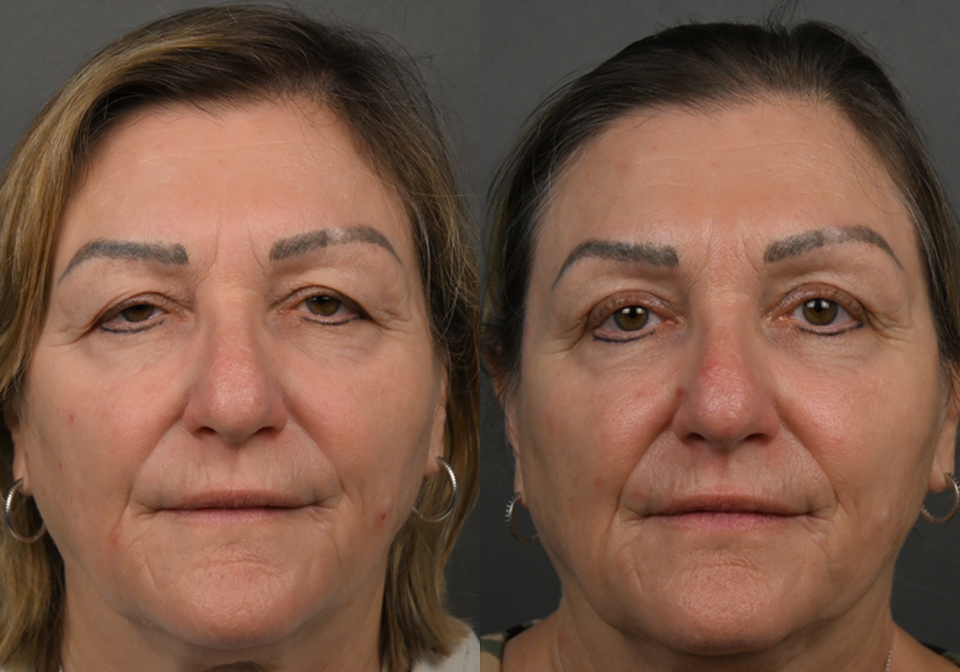 Blepharoplasty case #36183