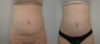 Tummy Tuck case #36784 slider thumbnail