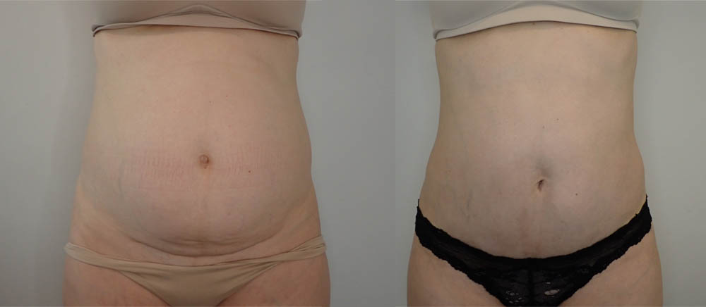 Tummy Tuck case #36784
