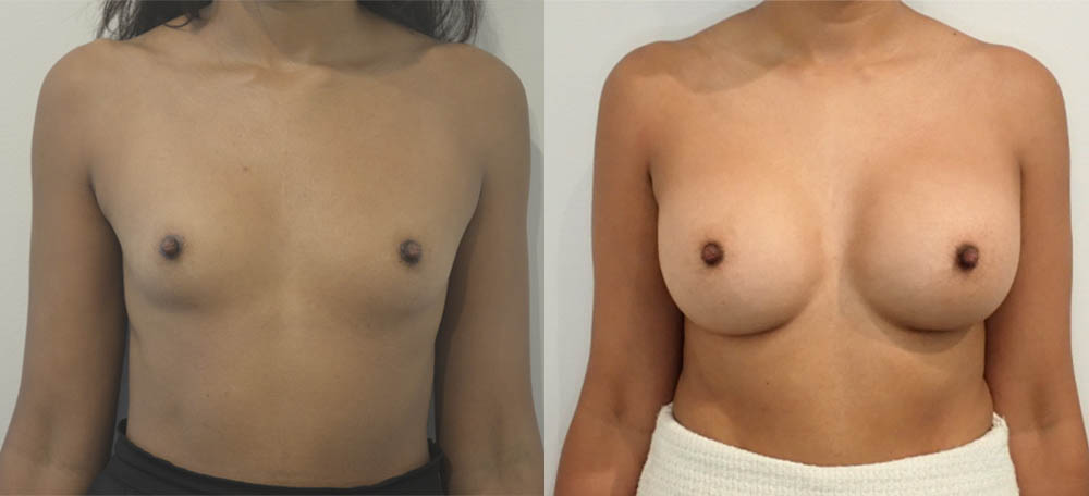 Breast Augmentation case #36788