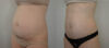 Tummy Tuck case #36784 slider thumbnail