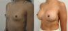 Breast Augmentation case #36788 slider thumbnail