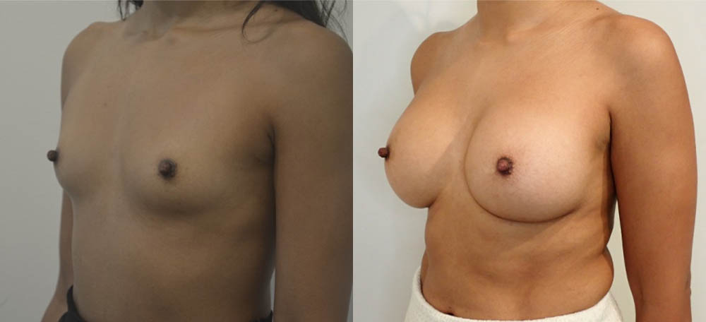 Breast Augmentation case #36788