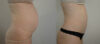 Tummy Tuck case #36784 slider thumbnail