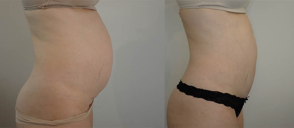 Tummy Tuck case #36784