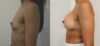Breast Augmentation case #36788 slider thumbnail