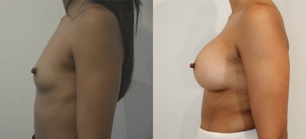 Breast Augmentation case #36788