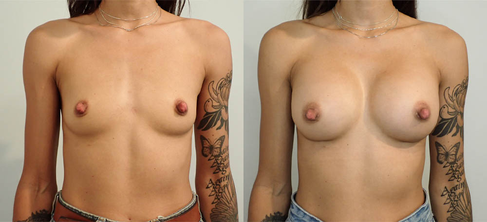 Breast Augmentation case #36792
