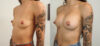 Breast Augmentation case #36792 slider thumbnail