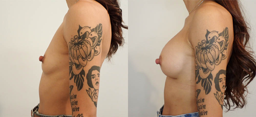 Breast Augmentation case #36792