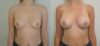 Breast Augmentation case #36796 slider thumbnail