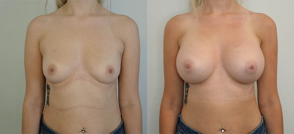 Breast Augmentation case #36796