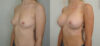 Breast Augmentation case #36796 slider thumbnail