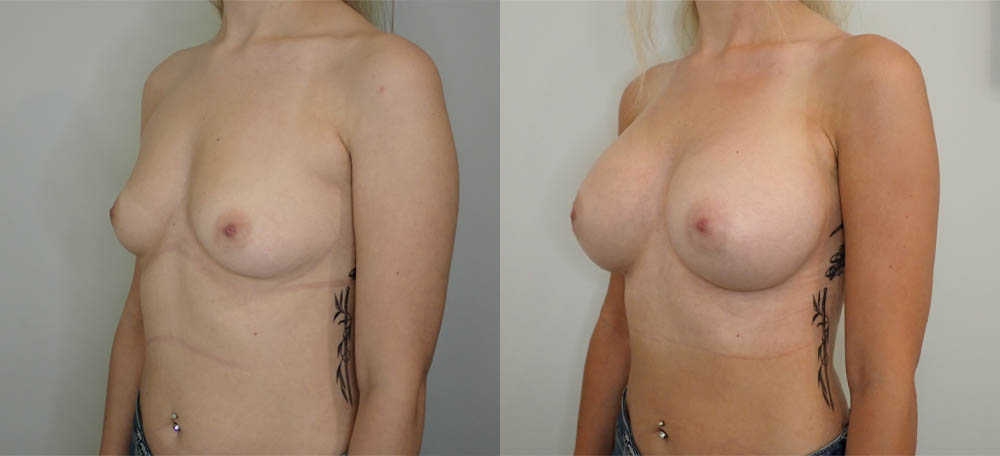 Breast Augmentation case #36796