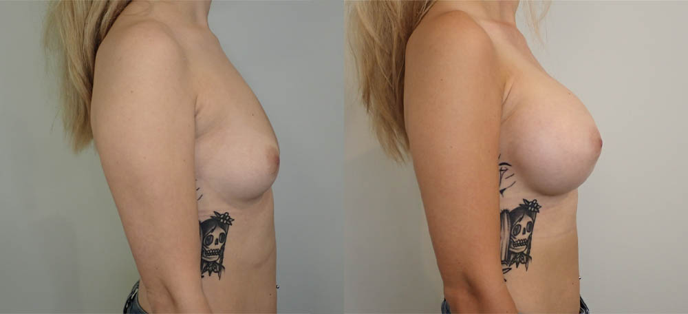 Breast Augmentation case #36796