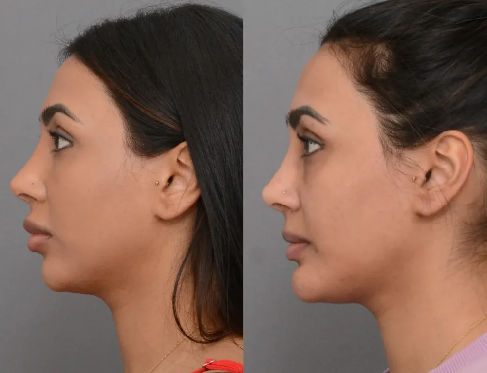 Chin Augmentation case #40384