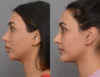 Chin Augmentation case #40384 slider thumbnail