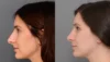 Primary Rhinoplasty case #40380 slider thumbnail