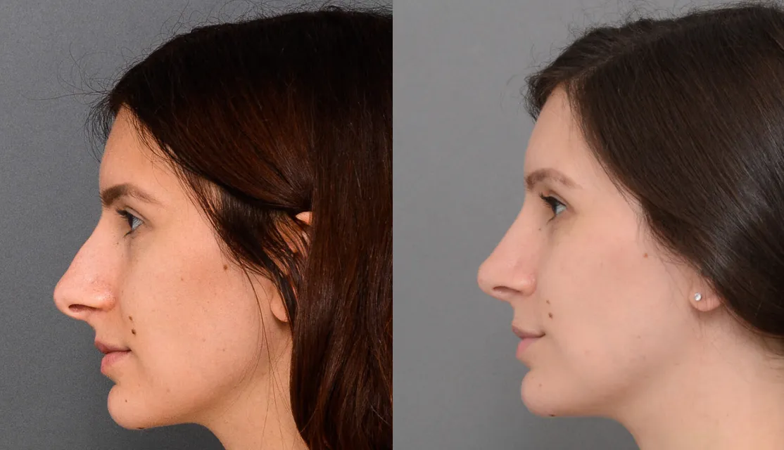 Primary Rhinoplasty case #40380